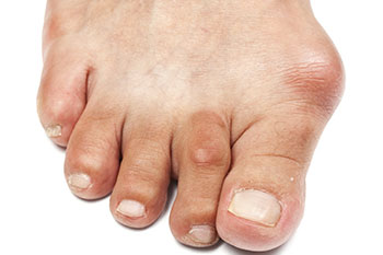 Bunions Treatment in the Ocean County, NJ: Toms River (Beachwood, Berkeley Township, Lacey Township, Ocean Twp, Anchorage, Brick Township, Seaside Heights, Lavallette, Barnegat Township, Manchester Township, Lakehurst) area