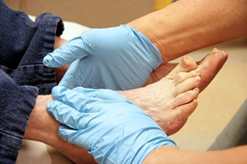 Diabetic foot treatment in the Ocean County, NJ: Toms River (Beachwood, Berkeley Township, Lacey Township, Ocean Twp, Anchorage, Brick Township, Seaside Heights, Lavallette, Barnegat Township, Manchester Township, Lakehurst) area