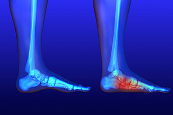 Flat feet treatment in the Ocean County, NJ: Toms River (Beachwood, Berkeley Township, Lacey Township, Ocean Twp, Anchorage, Brick Township, Seaside Heights, Lavallette, Barnegat Township, Manchester Township, Lakehurst) area
