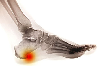Heel spur treatment in the Ocean County, NJ: Toms River (Beachwood, Berkeley Township, Lacey Township, Ocean Twp, Anchorage, Brick Township, Seaside Heights, Lavallette, Barnegat Township, Manchester Township, Lakehurst) area