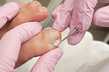 Ingrown toenail treatment in the Ocean County, NJ: Toms River (Beachwood, Berkeley Township, Lacey Township, Ocean Twp, Anchorage, Brick Township, Seaside Heights, Lavallette, Barnegat Township, Manchester Township, Lakehurst) area