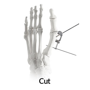 nanoplasty