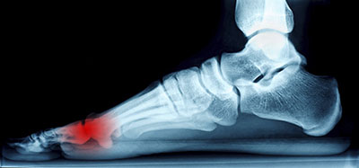Morton's neuromas treatment in the Ocean County, NJ: Toms River (Beachwood, Berkeley Township, Lacey Township, Ocean Twp, Anchorage, Brick Township, Seaside Heights, Lavallette, Barnegat Township, Manchester Township, Lakehurst) area