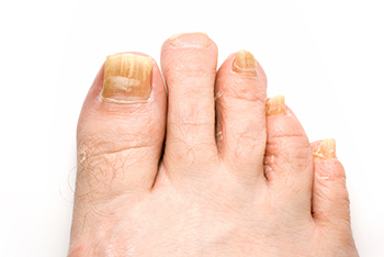 Toenail fungus treatment in the Ocean County, NJ: Toms River (Beachwood, Berkeley Township, Lacey Township, Ocean Twp, Anchorage, Brick Township, Seaside Heights, Lavallette, Barnegat Township, Manchester Township, Lakehurst) area
