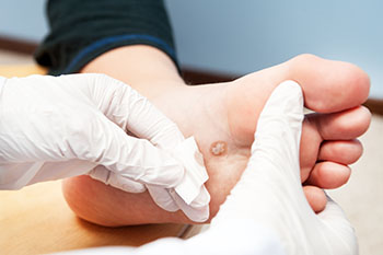 Plantar warts treatment in the Ocean County, NJ: Toms River (Beachwood, Berkeley Township, Lacey Township, Ocean Twp, Anchorage, Brick Township, Seaside Heights, Lavallette, Barnegat Township, Manchester Township, Lakehurst) area